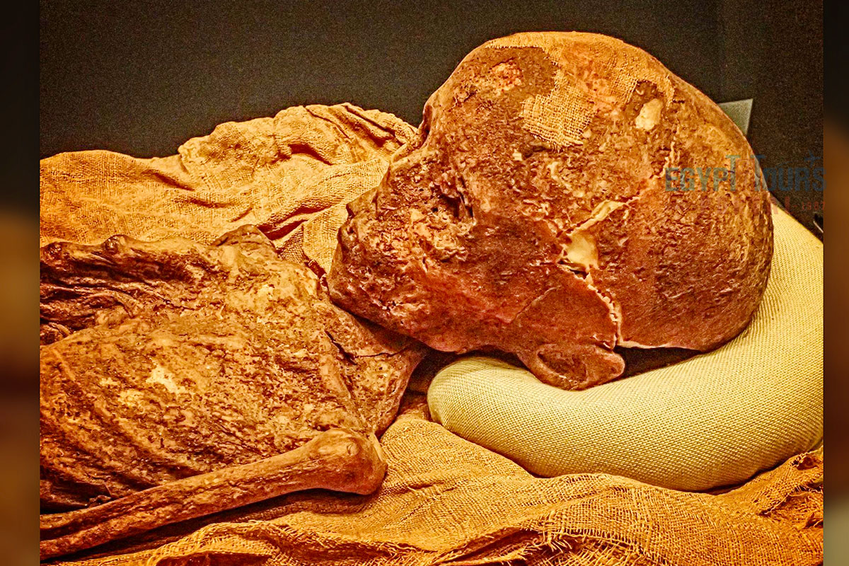 Diseases in Ancient Egypt - Egypt Tours Portal